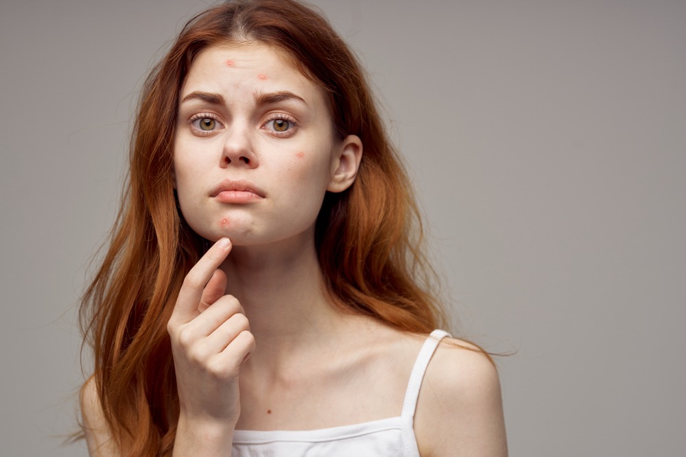HƯỚNG DẪN CÁCH CHĂM SÓC DA MỤN TUỔI DẬY THÌ